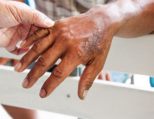 ПОТВРЂЕНА ГУБА НАКОН ВИШЕ ОД 30 ГОДИНА, ЗАРАЖЕН СТРАНИ РАДНИК