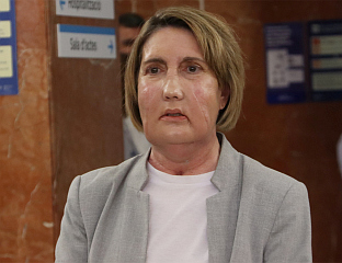 У БАРСЕЛОНИ ИЗВЕДЕНА ПИОНИРСКА ТРАНСПЛАНТАЦИЈА ЛИЦА