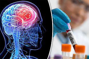 НОВИ ТЕСТ КРВИ ОТКРИВА ТУМОРЕ МОЗГА